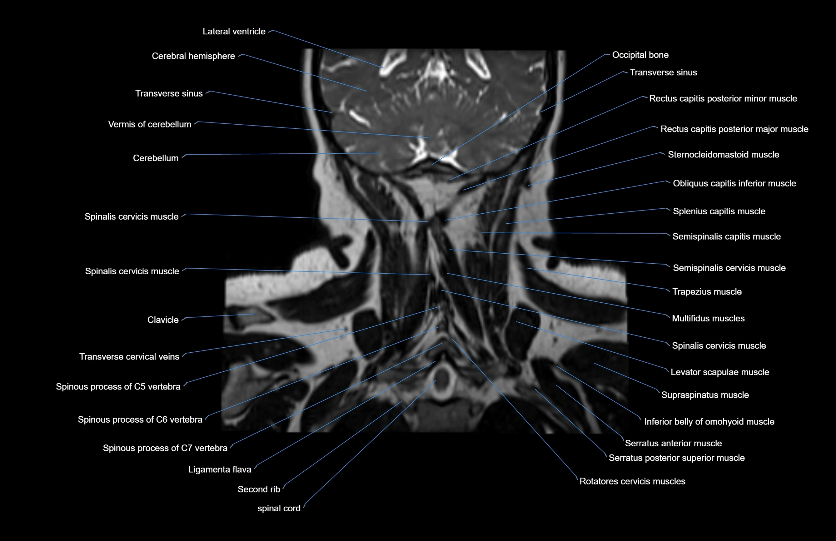 Neck coronal cross sectional MRI anatomy 3T MRI  image-img-00001-00013.webp